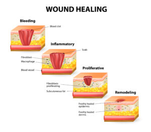 Seasonal Wound Care in Las Vegas and Henderson: Summer vs. Winter Risks